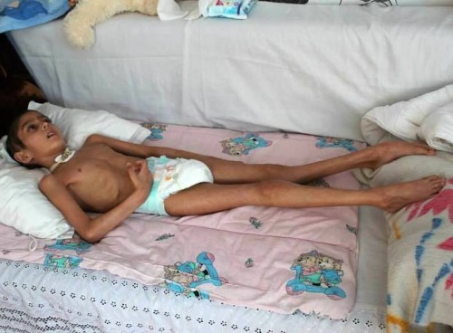 Помогнете на 8-годишния Елвер, той е в будна кома и страда от системно недохранване